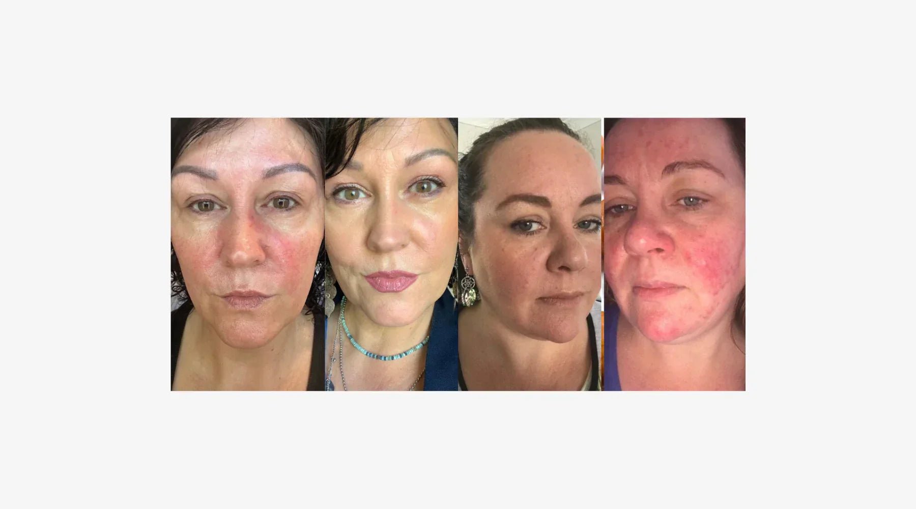 How to Cover Up Redness on Face Naturally With Mineral Makeup - Adorn Cosmetics