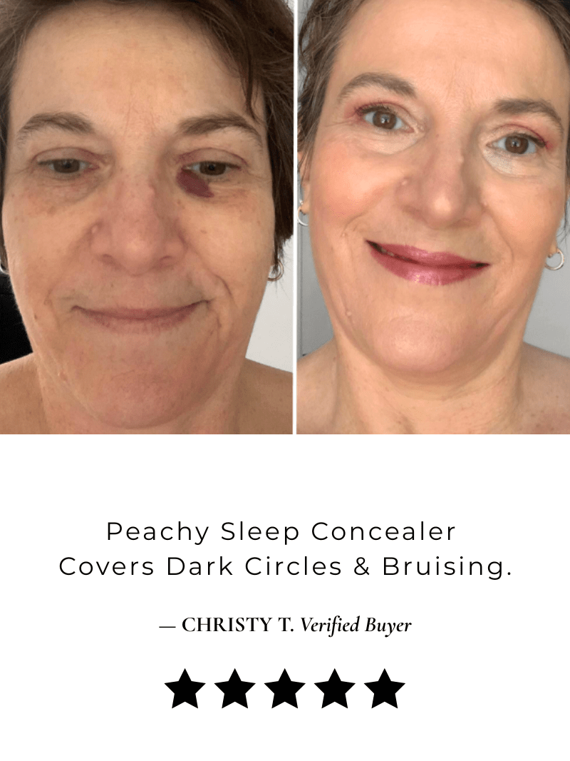 Before and after comparison of birth mark cream concealer covers dark circles and bruising on a woman's face with text about peachy sleep concealer.